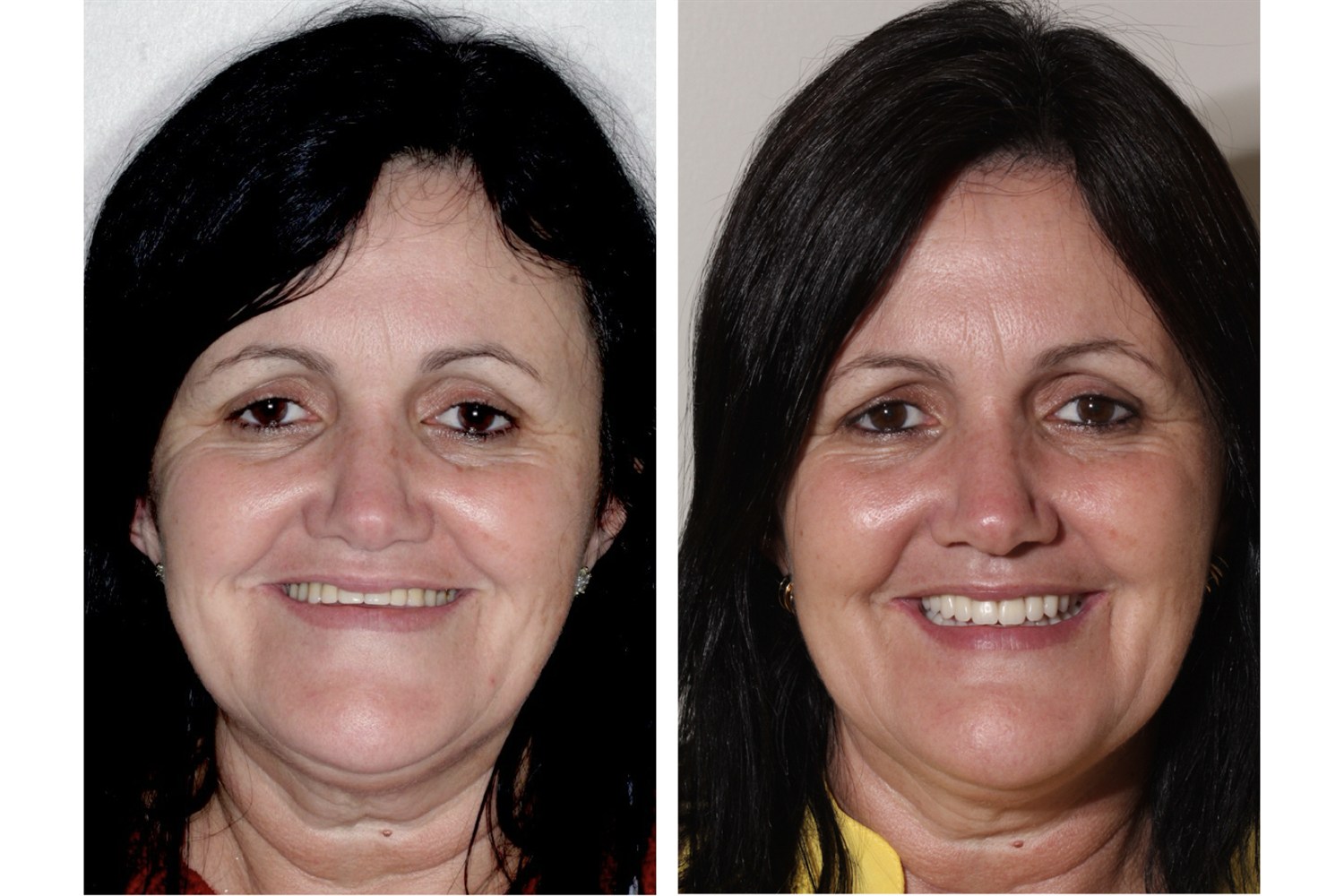 Caso real de paciente — antes e depois do tratamento