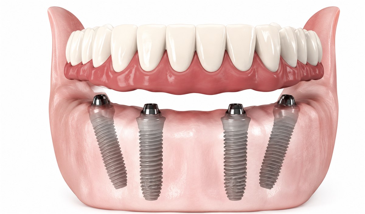 Ilustração: arcada de baixo com dentes fixos presos sobre implantes